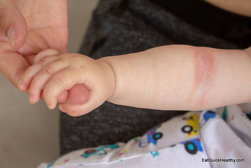 can you use coconut oil for diaper rash