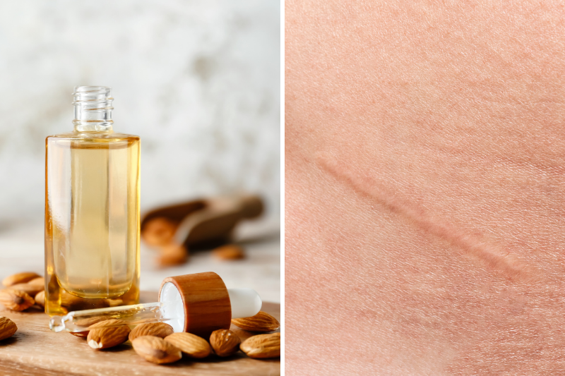Almond Oil For Scars: Benefits And How To Use