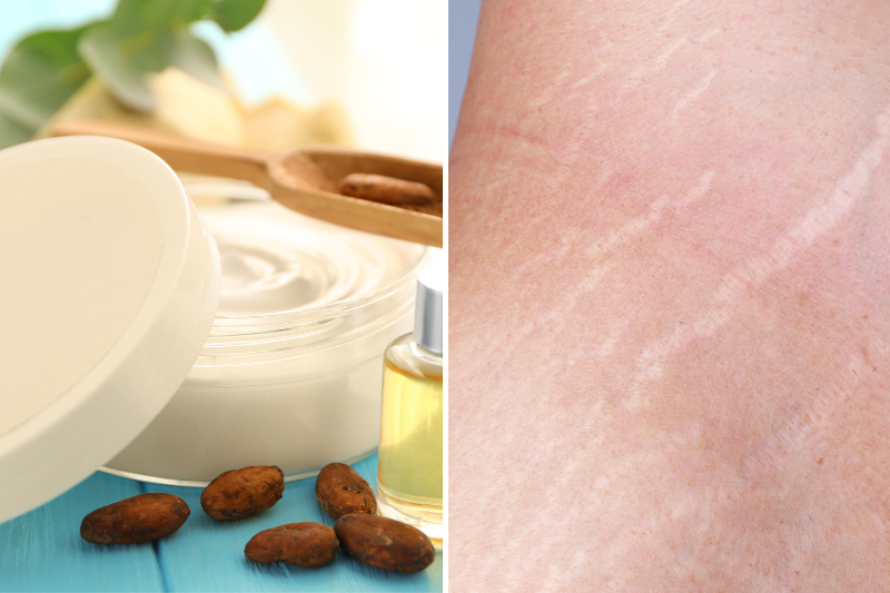 Cocoa Butter For Stretch Marks: Does It Work? [Full Guide]
