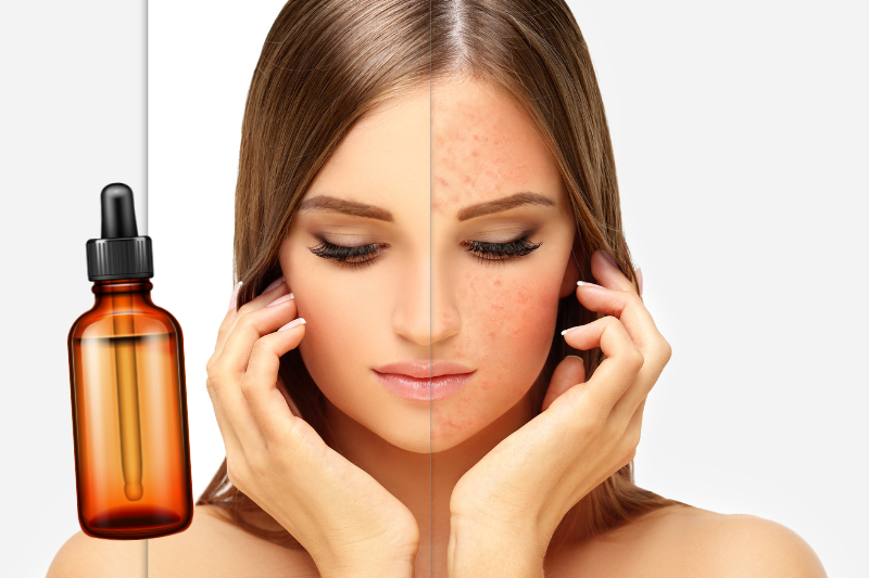 Rosacea Oil Cleansing: Everything You Need To Know About Using An Oil Cleanser For Rosacea