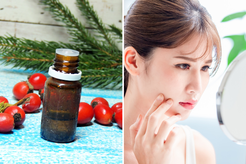 Rosehip Oil For Oily Skin: Benefits And How To Use Rosehip Oil For Oily Skin